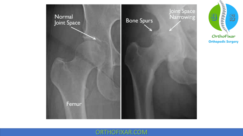 Hip Joint Osteoarthritis xray