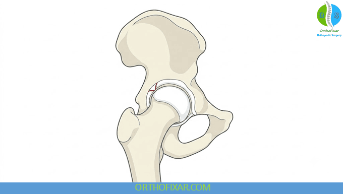 Hip Labral Tear
