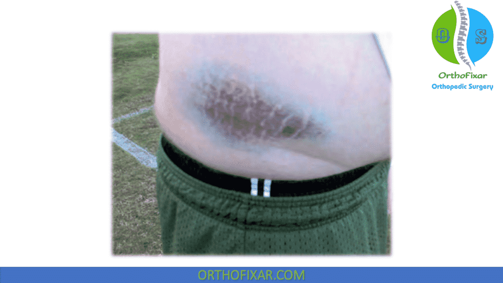 hip flexor bruise