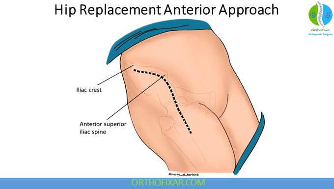 Anterior vs Posterior Hip Replacement: Key Differences 4 Hip Replacement Anterior Approach