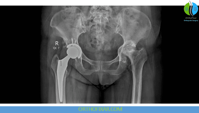 Hip Replacement Candidate
