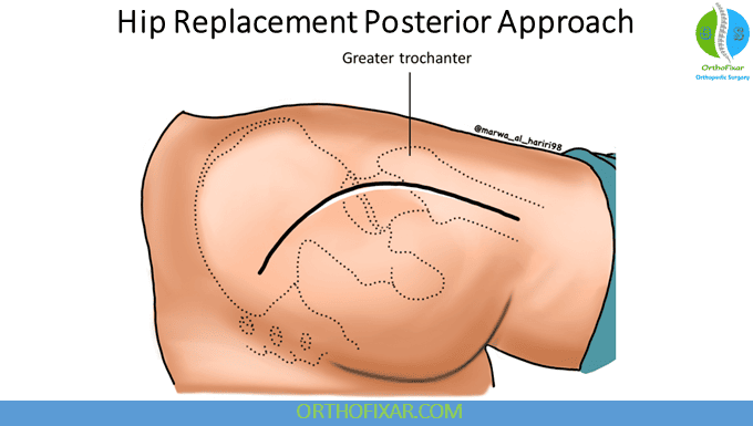 Anterior vs Posterior Hip Replacement: Key Differences 5 Hip Replacement Posterior Approach