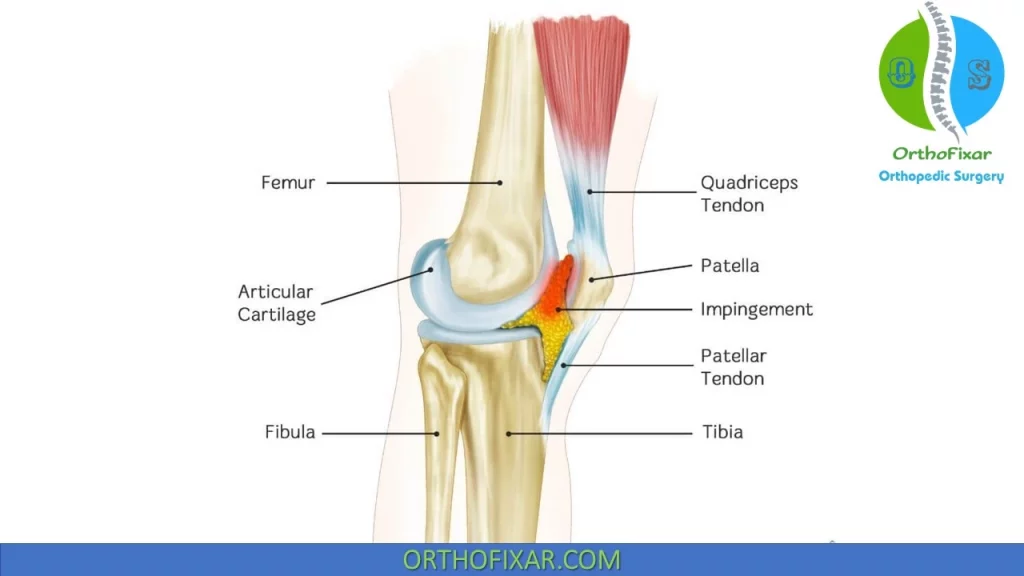 Hoffa's fat pad impingement