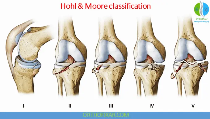 Tibial Plateau Fracture 9 Hohl and Moore classification for Tibial Plateau Fracture