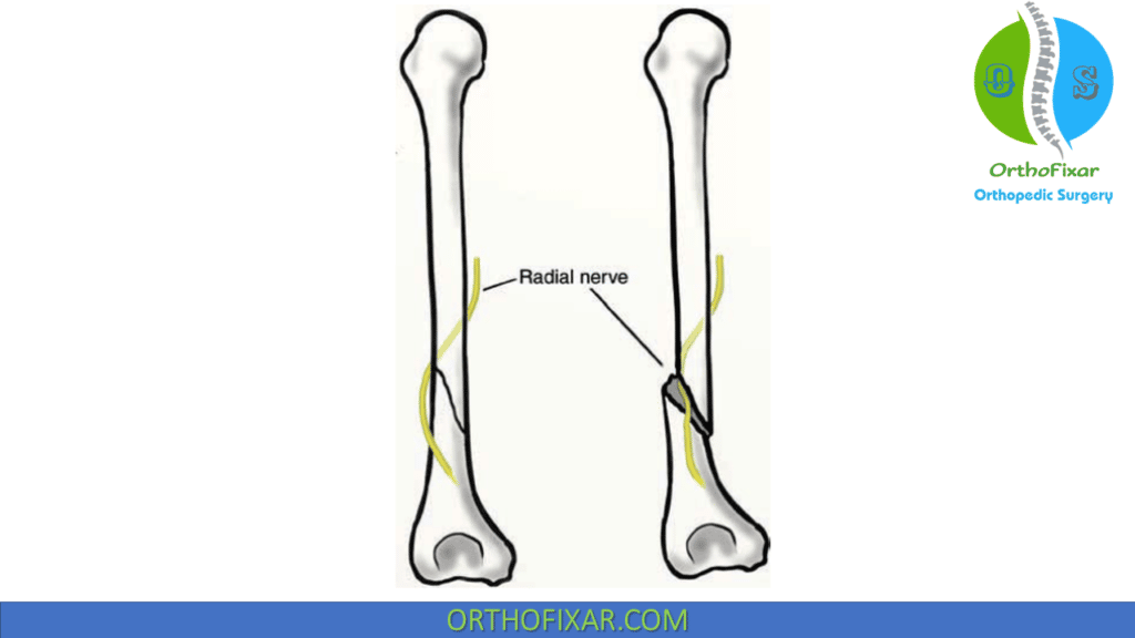 Humeral Shaft Fractures 0321