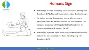homans sign test- positive homans sign