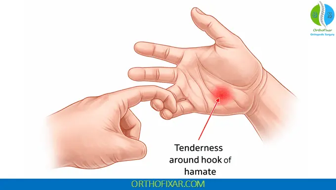 Hook of Hamate Pull Test - Hamate fracture test