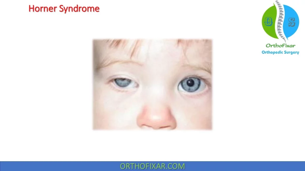 Horner's syndrome