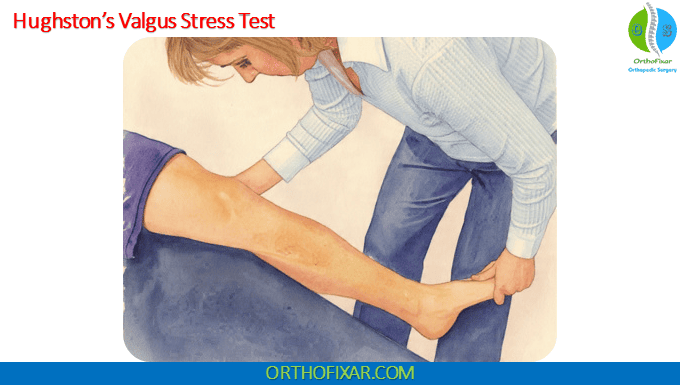 Valgus Stress Test of the Knee 3 Hughston’s valgus stress test