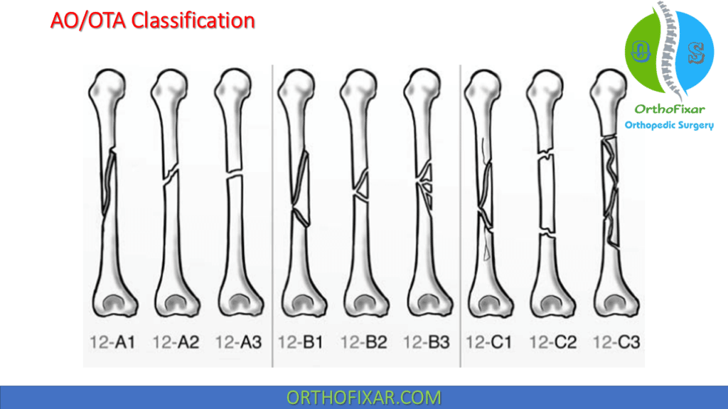 Humeral Shaft Fractures AO OTA calssification