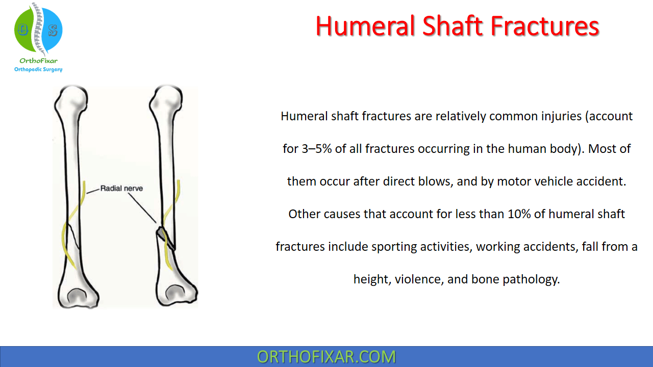 hanging arm cast for humerus fracture