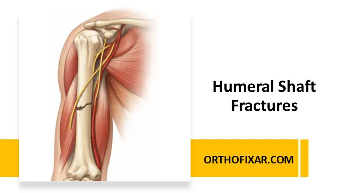 Humeral Shaft Fractures