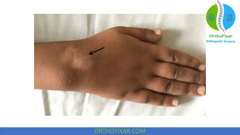 Hypopigmentation after intra-articular corticosteroid injection