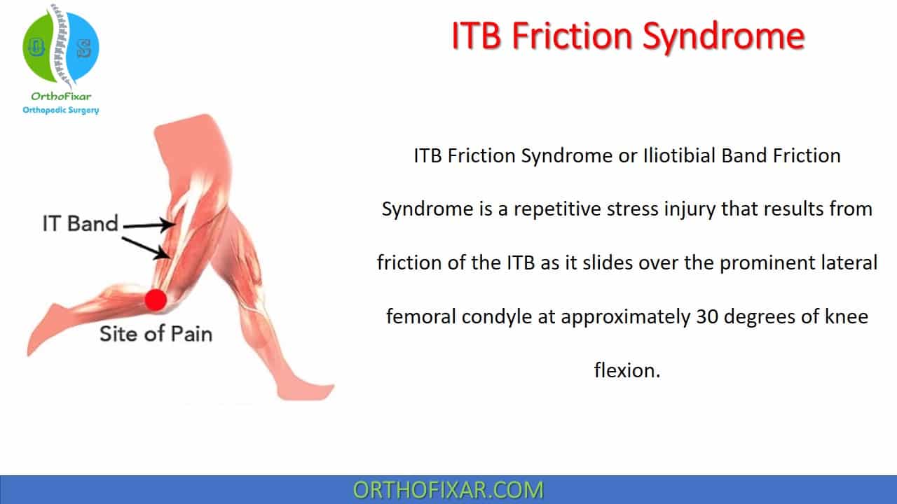  ITB Friction Syndrome 