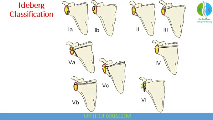 Ideberg Classification Glenoid Fractures