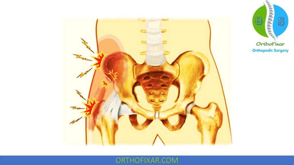 pain along iliac crest