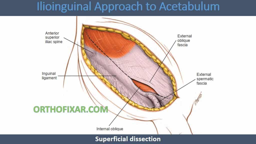 Ilioinguinal Approach to Acetabulum