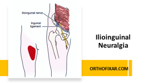 Ilioinguinal Neuralgia Overview