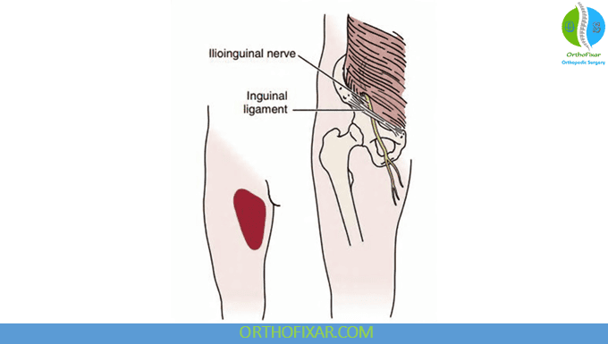 Ilioinguinal Neuralgia Overview 2 Ilioinguinal Neuralgia -Ilioinguinal Nerve entrapment