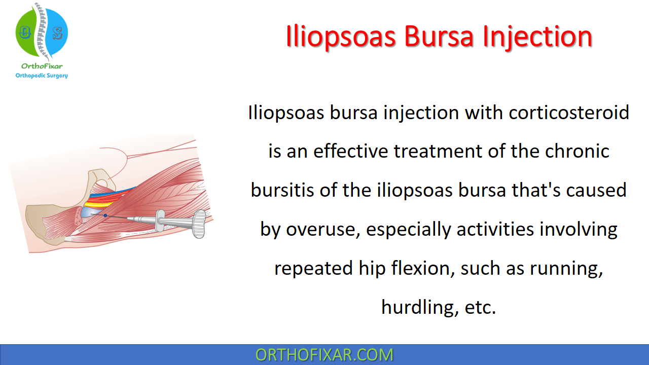 Iliopsoas Bursitis Or Iliopectineal Bursitiscauses