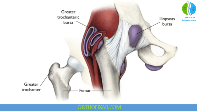 Iliopsoas Bursitis