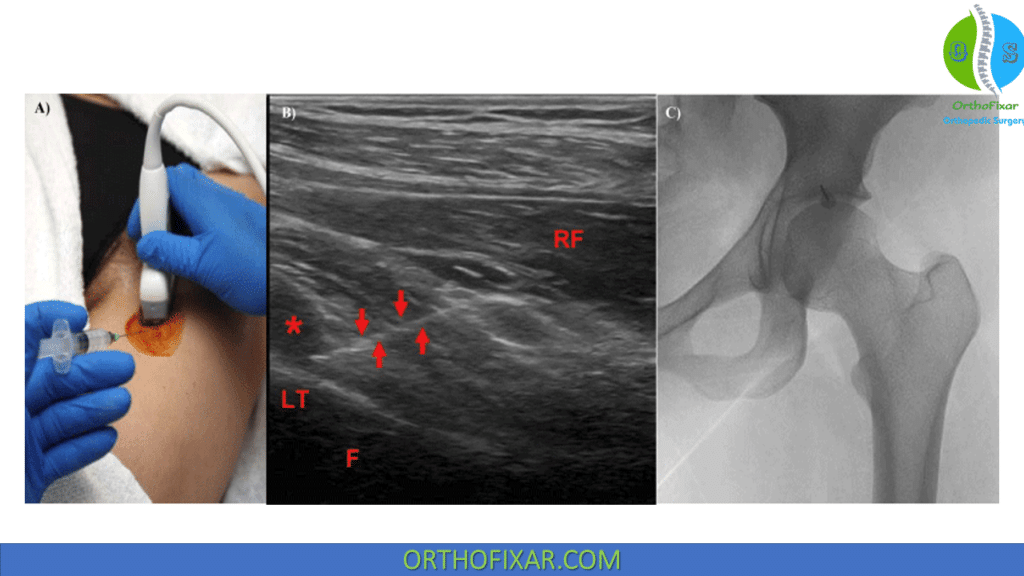 Iliopsoas bursa injection ultrasound technique