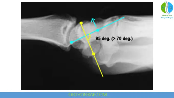 Increased Scapholunate Angle