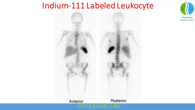 Bone Scan Radionuclide Imaging: Principles, Applications & Interpretation 9 Indium-111 Labeled Leukocyte Imaging