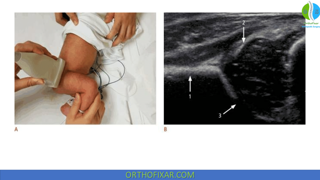 Infant Hip Ultrasound landmarks