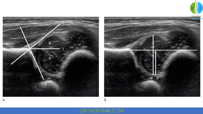 Infant Hip alpha and beta angle ultrasound
