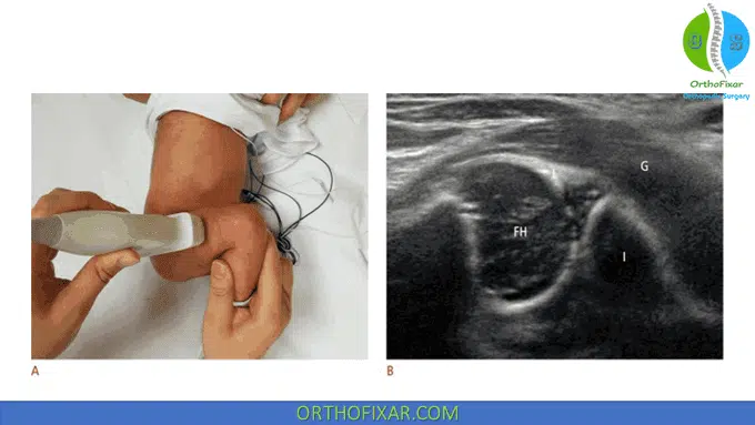 Infant Hip flexion ultrasonography