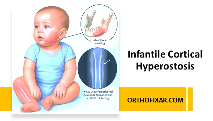 Infantile Cortical Hyperostosis