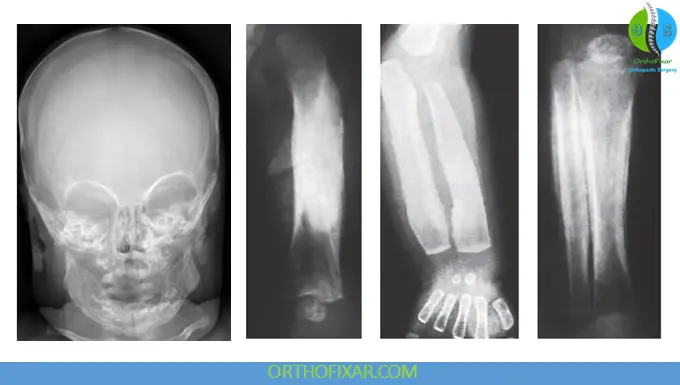 Infantile Cortical Hyperostosis (Caffey Disease): Symptoms, Diagnosis & Treatment 3 Infantile Cortical Hyperostosis xray