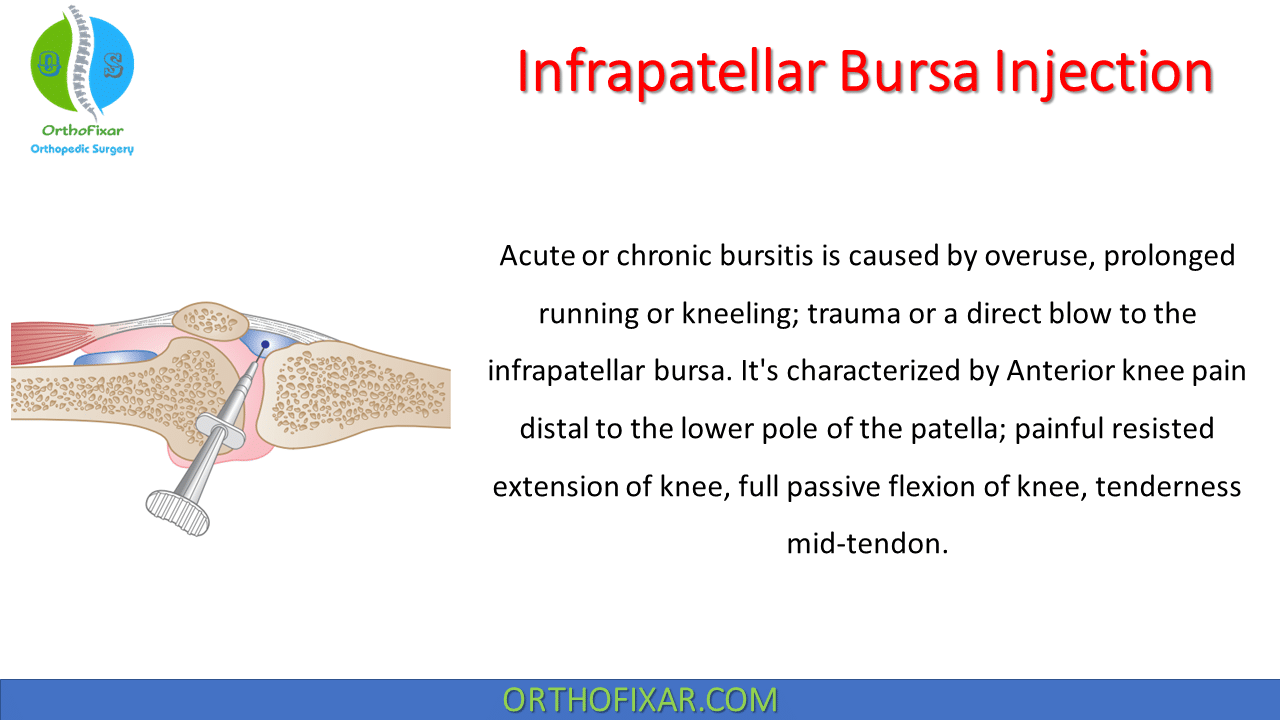 Infrapatellar Bursa Injection