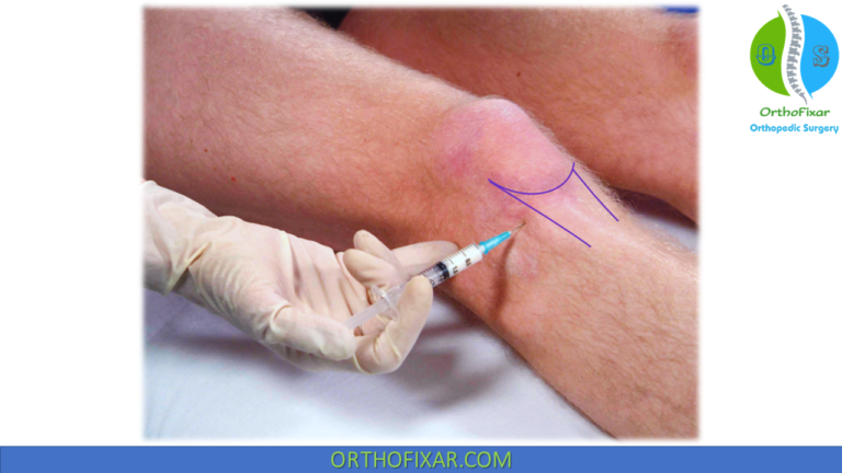 Infrapatellar Bursa Injection: Technique, Equipment, And Recovery Guide