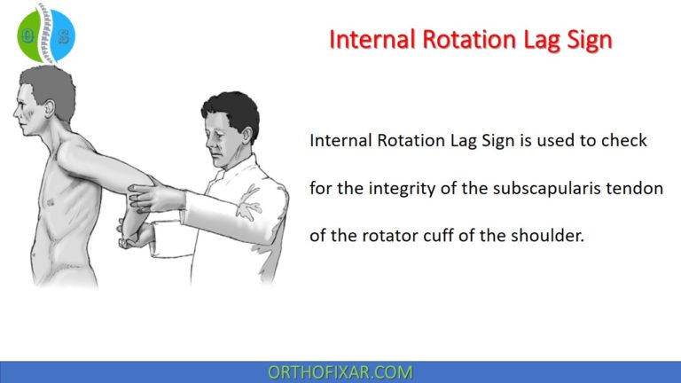 Internal Rotation Lag Sign