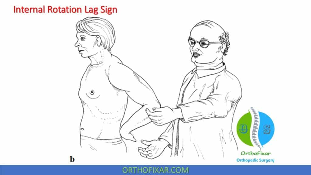 Internal Rotation Lag Sign