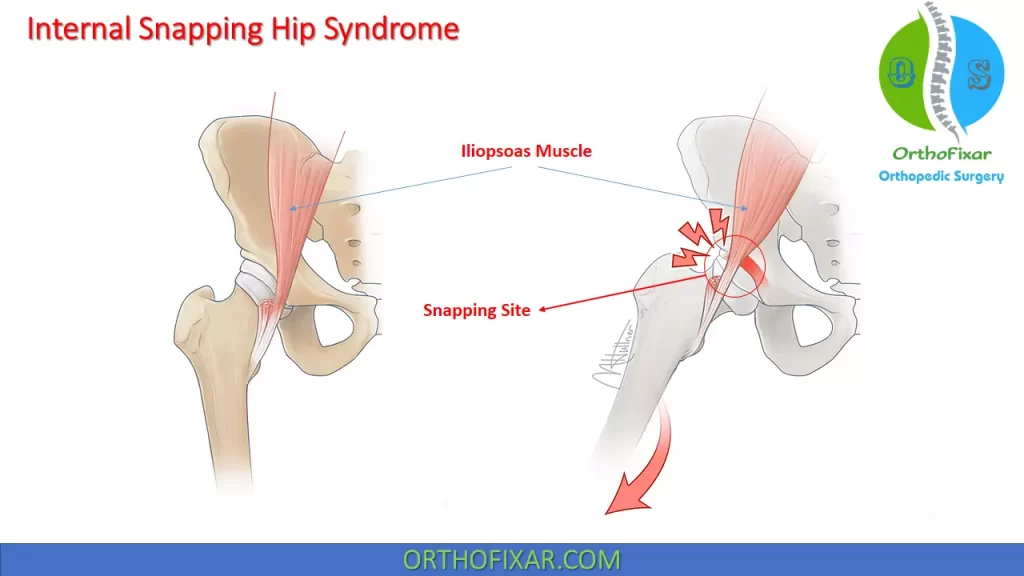 Internal Snapping Hip Syndrome