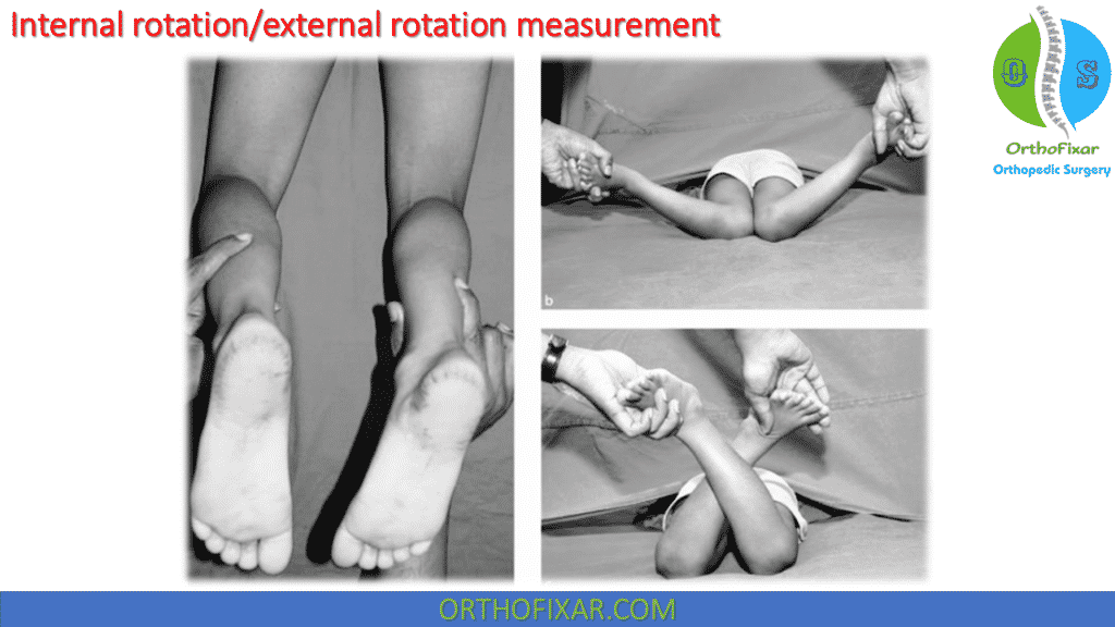 Internal rotationexternal rotation measurement