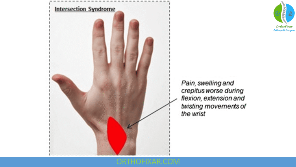 Intersection Syndrome: Dorsal Wrist Pain Causes & Treatment 7 Intersection Syndrome