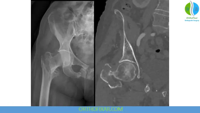 Intertrochanteric fracture xray