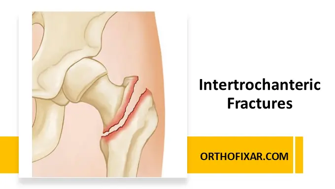 Intertrochanteric fracture
