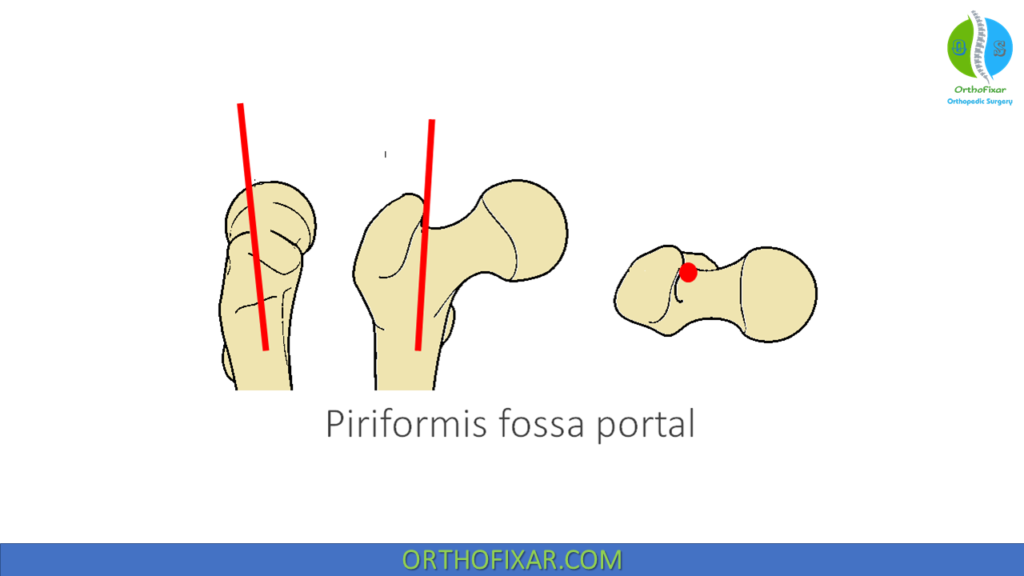 Intramedullary Femoral Nailing entry point