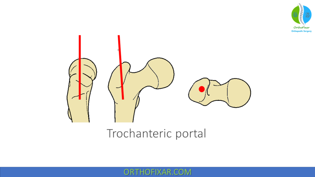 Intramedullary Femoral Nailing entry point 2