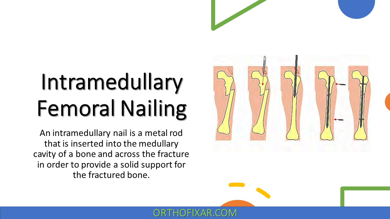 Intramedullary Femoral Nailing Procedure Benefits Recovery