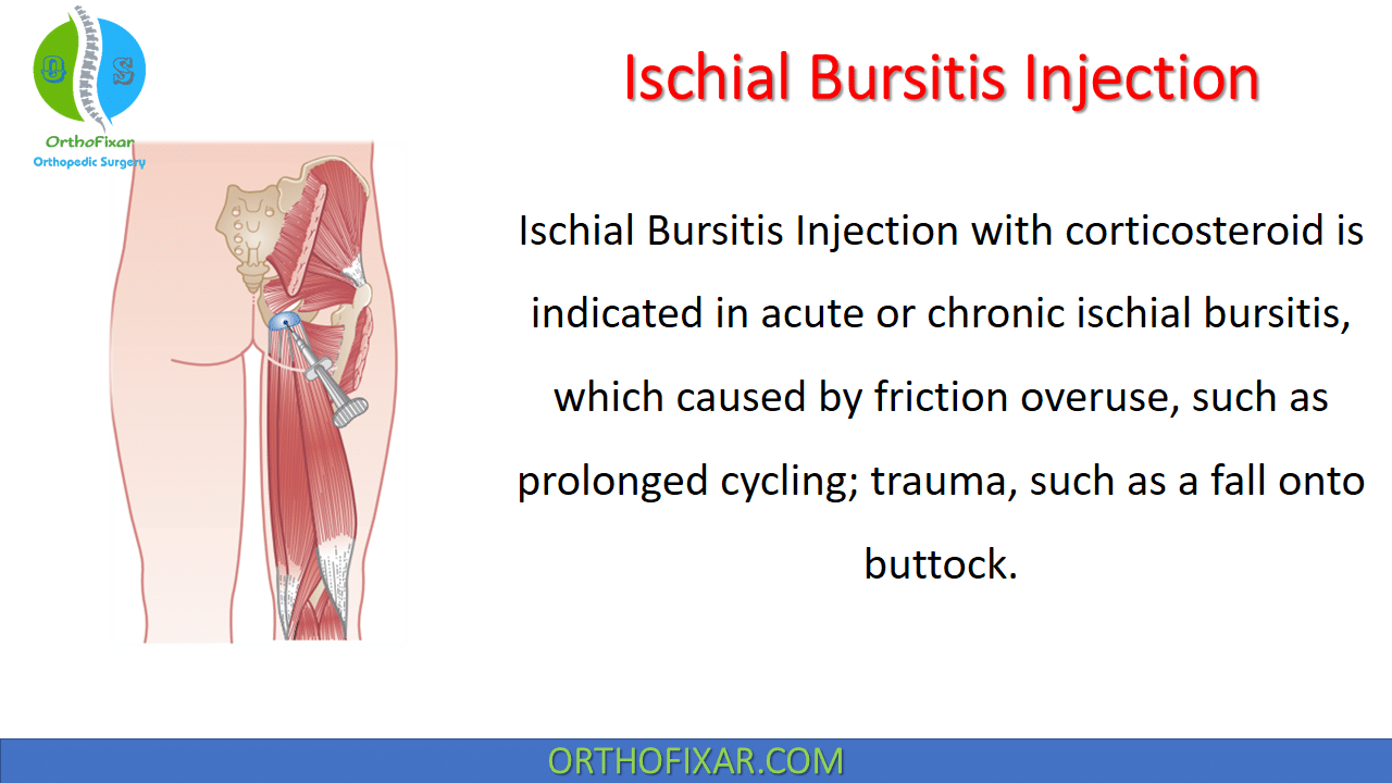Ischial Bursitis Injection