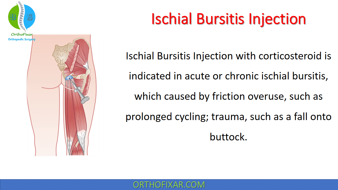 Ischial bursitis – BodSupport