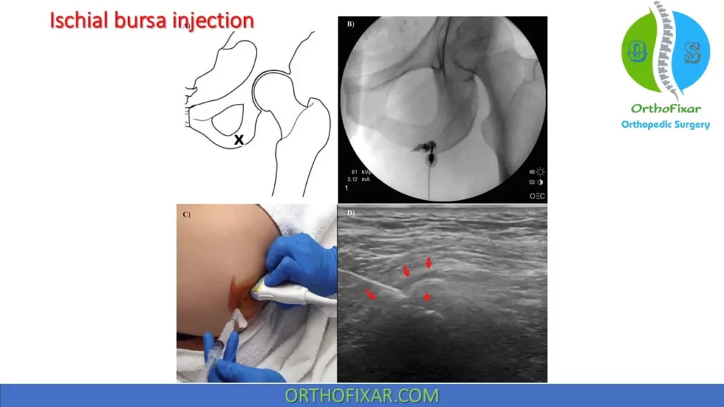 Ischial Bursitis steroid injection