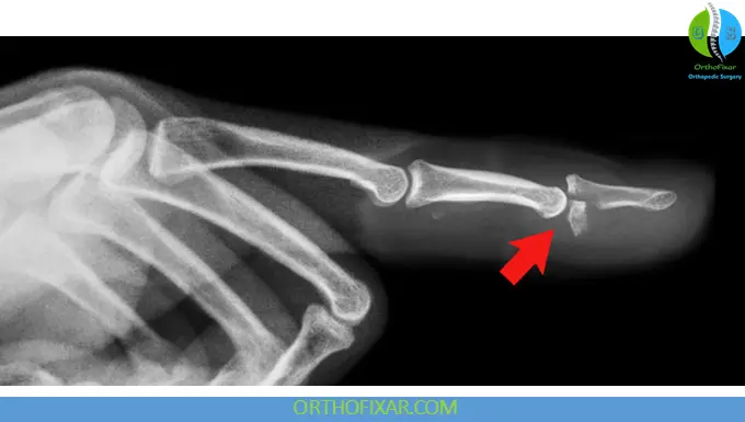 Jersey Finger xray