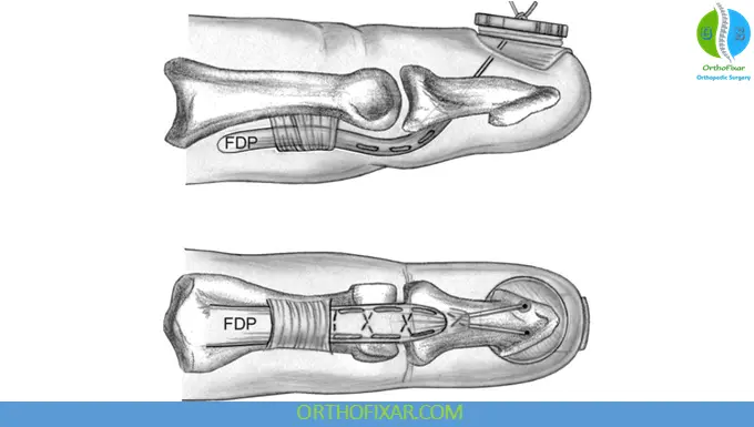 Jersey finger treatment